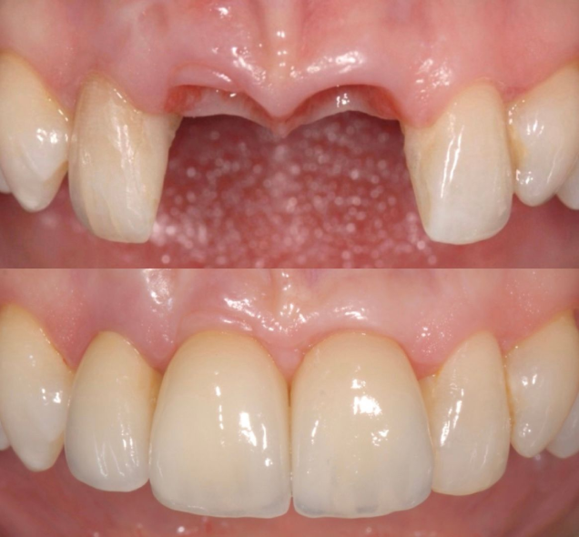 IMPLANTS MULTIPLES EN SECTEUR ESTHÉTIQUE