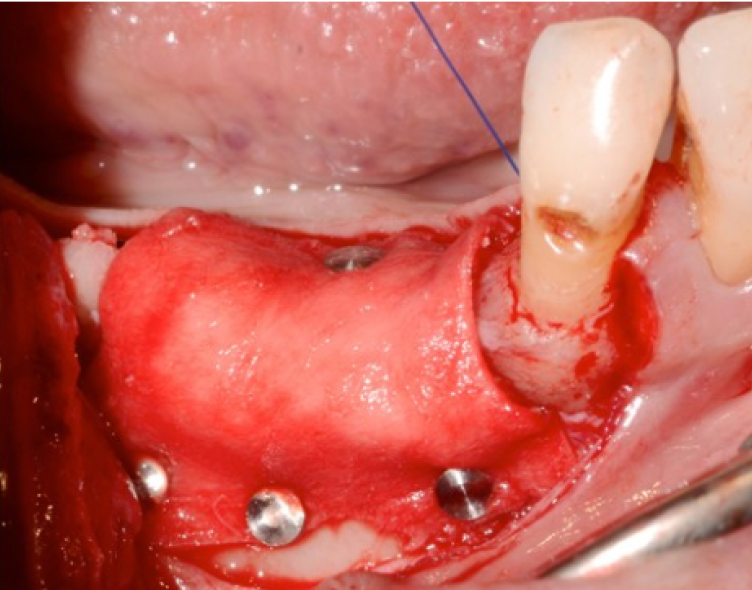 RÉGÉNÉRATION OSSEUSE GUIDÉE - GESTION DES ALVÉOLES D’EXTRACTION