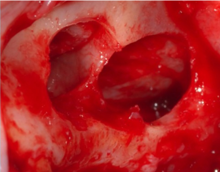 GREFFES DE SINUS - VOIES LATERALE / CRESTALE