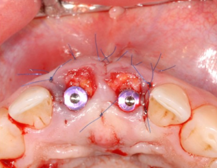 CHIRURGIE PLASTIQUE MUCO GINGIVALE IMPLANTAIRE