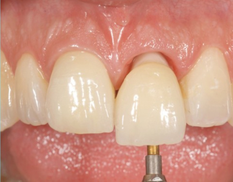 IMPLANT UNITAIRE EN SECTEUR ESTHÉTIQUE