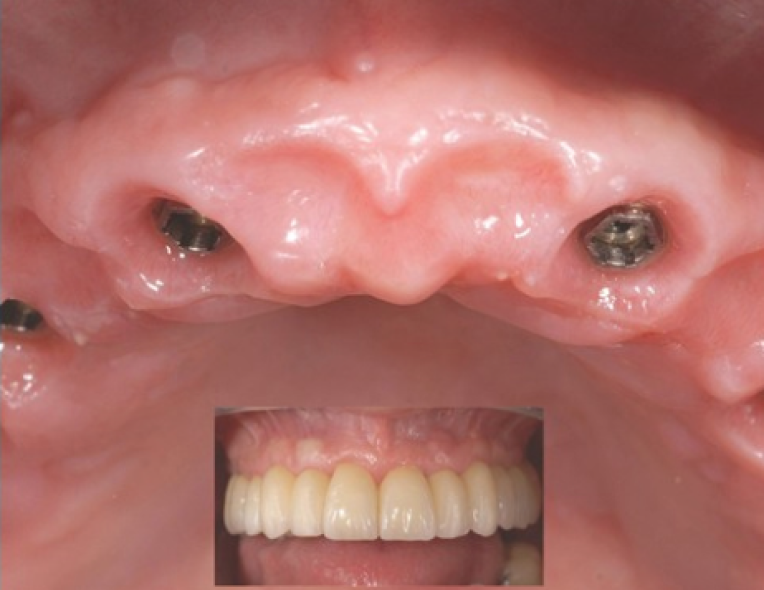 ÉDENTÉ TOTAL ET IMPLANTS