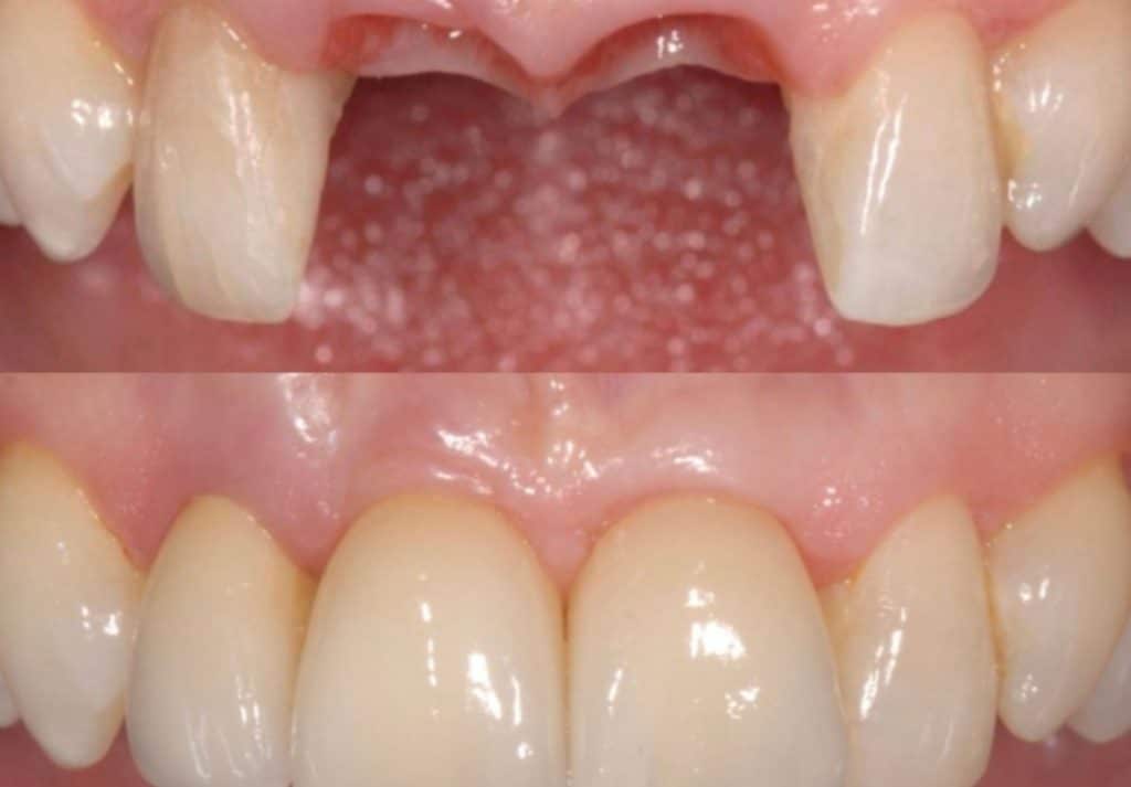 Implants multiples en secteur esthétique